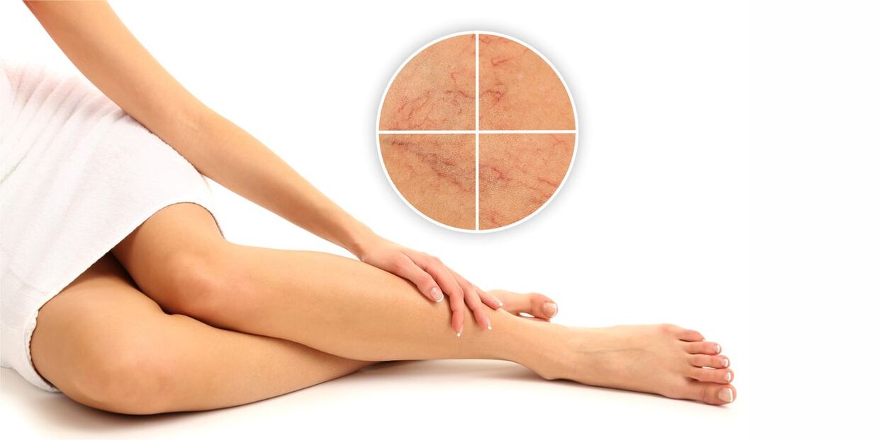 what is varicose veins on the legs